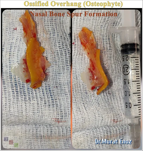 Nasal septal spur removal - bone spur formation treatment