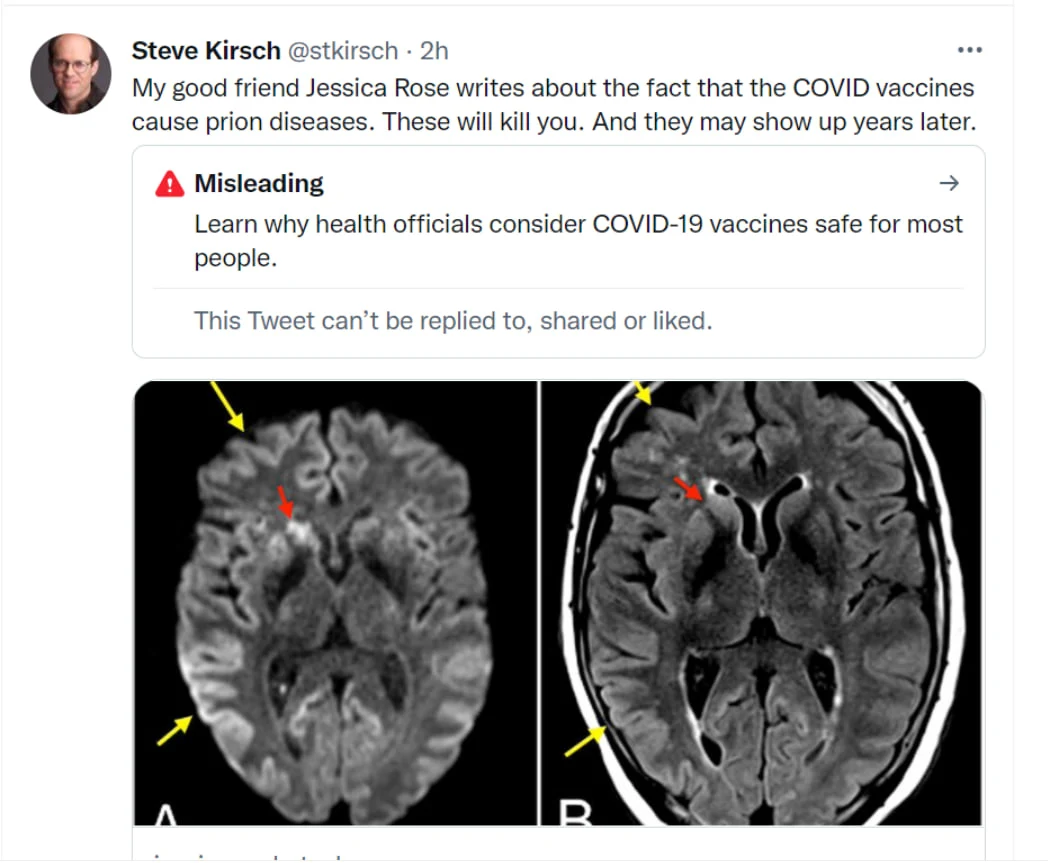 PROOF: COVID vaccines cause prion diseases