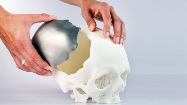 3D Printed Medical Implants enable manufacturers to develop complicated structures that reminiscent size and function of natural organs