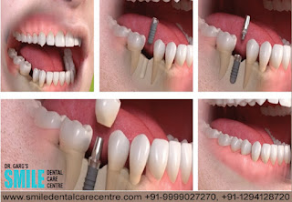 Best Dental Implant in Faridabad