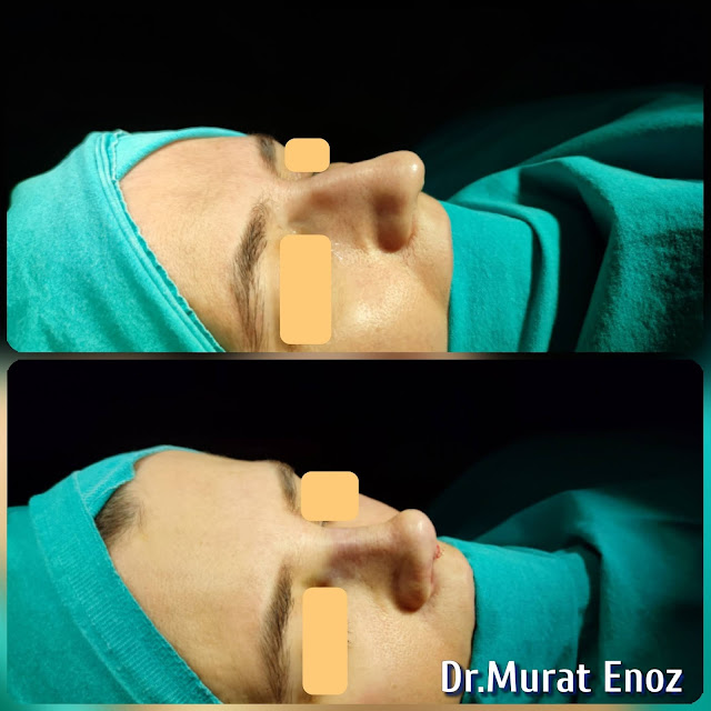 Natural nose aesthetic surgery for female,natural-looking rhinoplasty