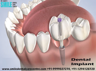 Dental Implant Clinic in Faridabad