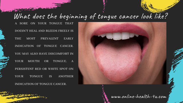 Define of Tongue Cancer and Signs and Symptoms Oral Cancer | Treatment
