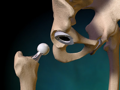 Hip Replacement Market