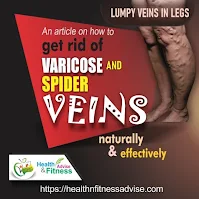 https://www.healthnfitnessadvise.com/2021/12/get-rid-of-varicose-and-spider-veins.html