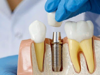 Cấy răng implant có đau không-2