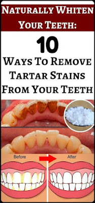 Naturally Whiten Teeth 10 Ways To Remove Tartar Stains From Your Teeth