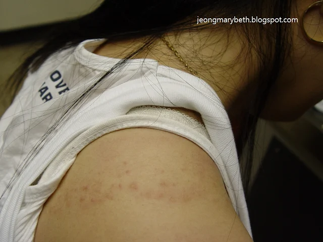 Allergic contact dermatitis due to metals (3) - image