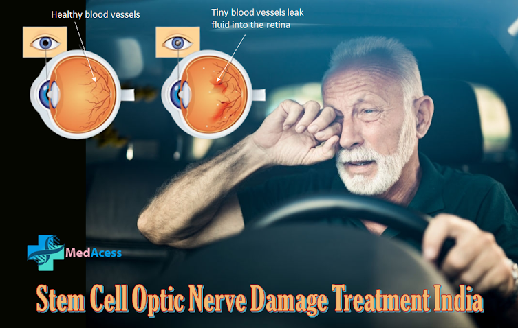 Stem Cell Optic Nerve Damage Treatment in India