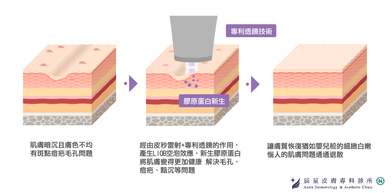 皮秒雷射懶人包