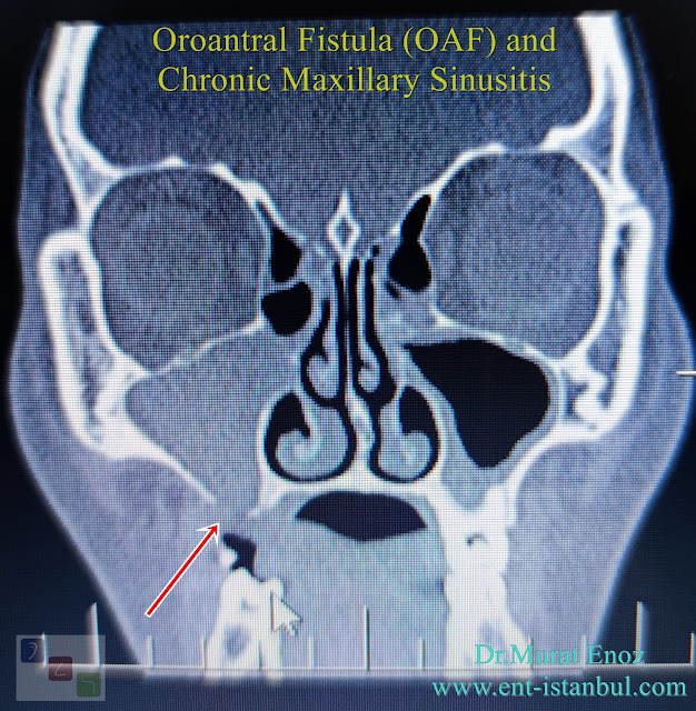 Chronic Maxillary Sinusitis,Oroantral fistula, OAF,Dental Sinusitis, Odontogenic Sinusitis,