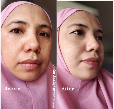 Before after pemakaian baby pink skincare