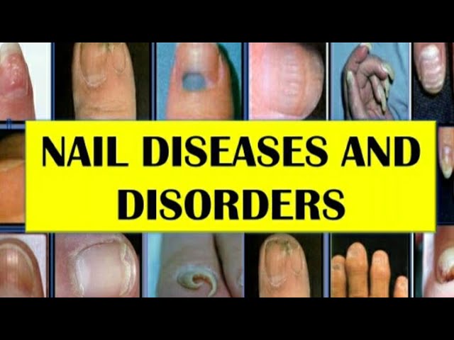 Medical Disorders And Nails