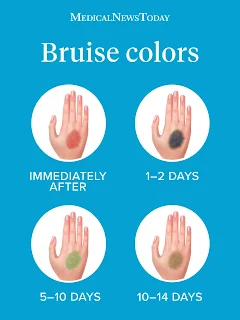 Bruise Colours