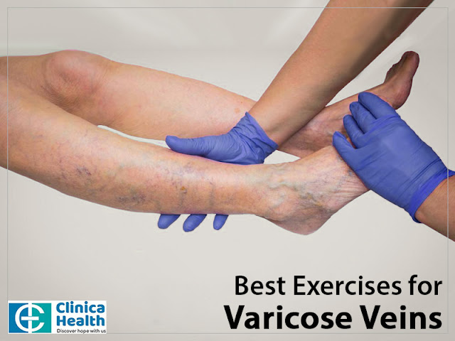 varicose vein laser surgery