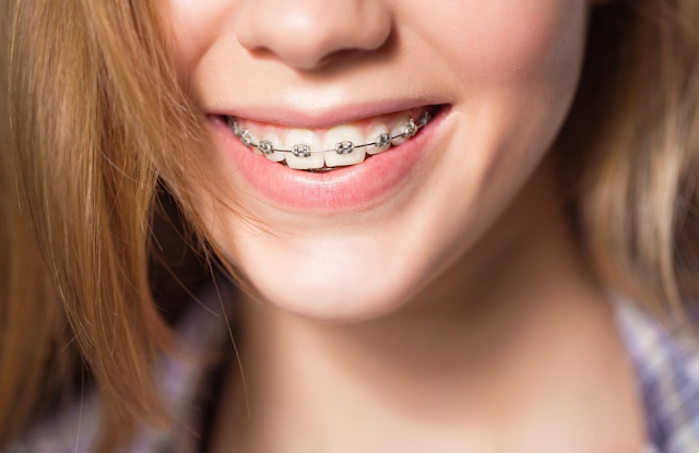 Niềng răng là gì? Lợi ích khi niềng răng