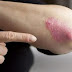 Psoriasis, its causes, symptoms, and how to treat it