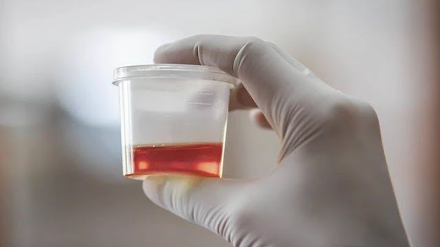 7 Ways Your Urine Is Telling You That Something Is Wrong With Your Body