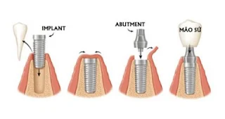 Cấy ghép răng implant trải qua giai đoạn nào-2