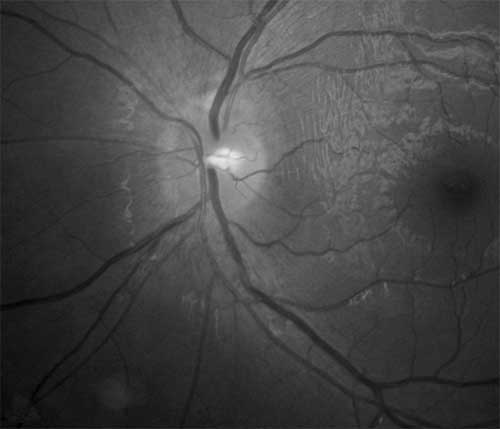 Optic Neuritis