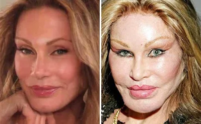 Plastic surgery addiction before and after