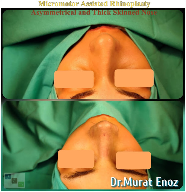 Micromotor Assisted Natural Rhinoplasty, Thick Skinned Nose Aesthetic, Hanging Columella,Drooping Columella, Female Nose Job in Istanbul,The tongue-in-groove technique
