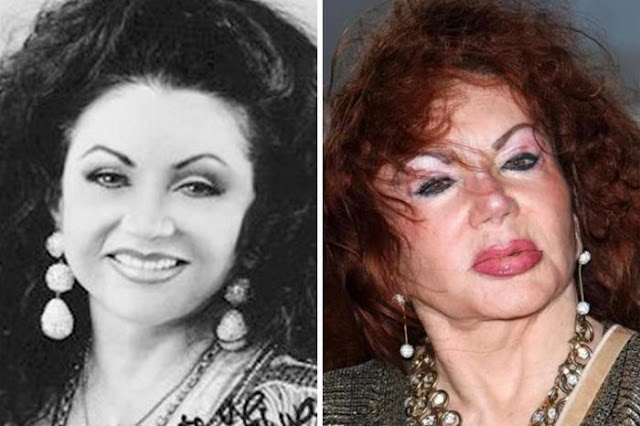 These are Hollywood celebrity's worst plastic surgery disasters