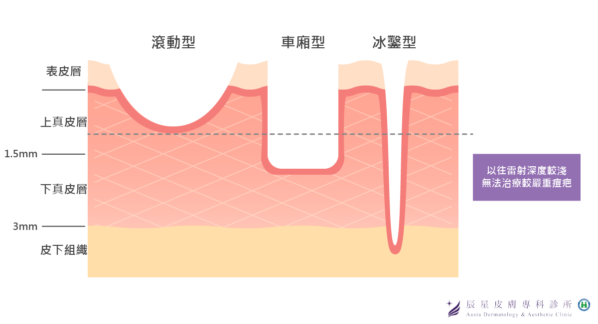 痘疤種類