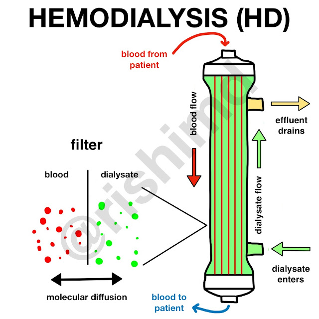 Hemodialysis Market