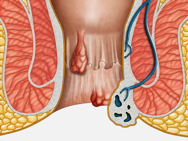 causes of piles | symptoms  | Treatments | piles phobia  piles, What do piles look like on your bum?,How do you get rid of piles in the bottom?,What is the main cause of piles?,How long does piles last?