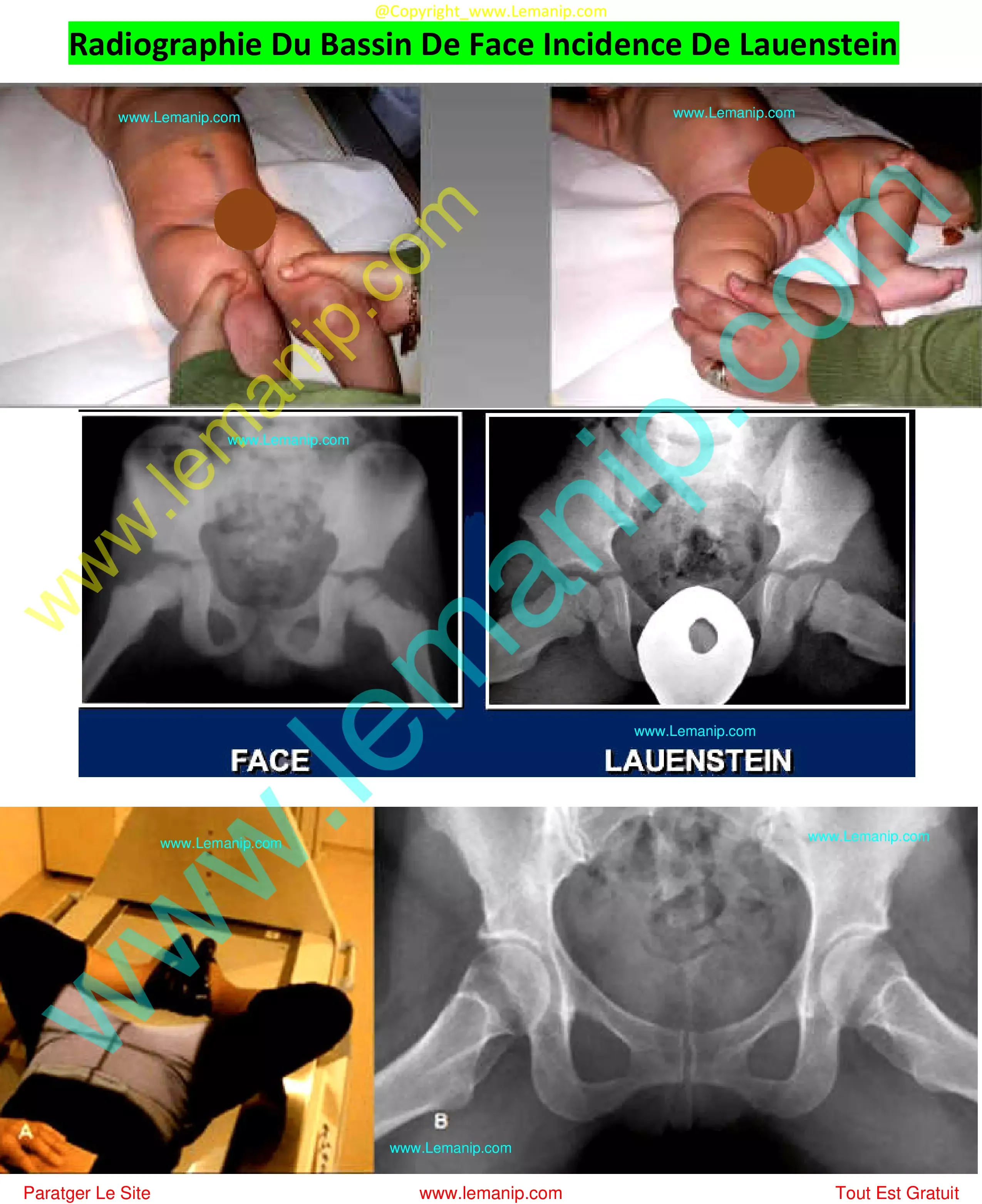 scoliosis hips uneven,hip abductor tear treatment,congenital hip dislocation,snapping hip syndrome surgery,subchondral fracture hip treatment,bilateral hip dysplasia infant,partial hip replacement after fracture,left hip impingement syndrome,avulsion fracture hip treatment,hip fracture surgery to connect broken bones internal fixation