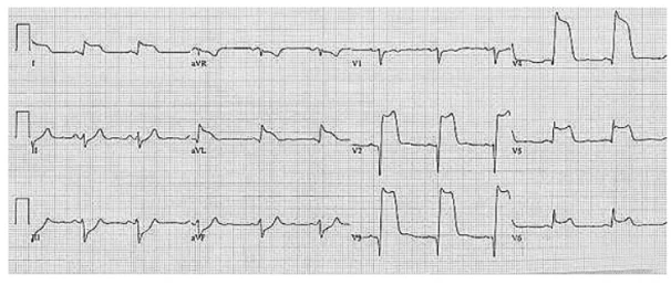 Realizado o seguinte ECG