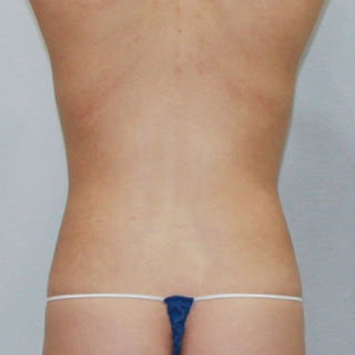 복부비만 복부지방흡입 복부비만건강 복부다이어트