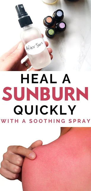 DIY Homemade Cream To Get Rid Of Sunburn And Heal Quickly