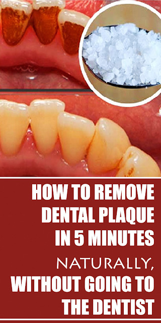 How to Remove Dental Plaque in 5 Minutes Naturally, without Going to the Dentist