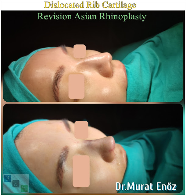 Ethnic Asian Thick Skinned Rhinoplasty Dislocated and Crooked Rib Cartilage - Asian Nose Job