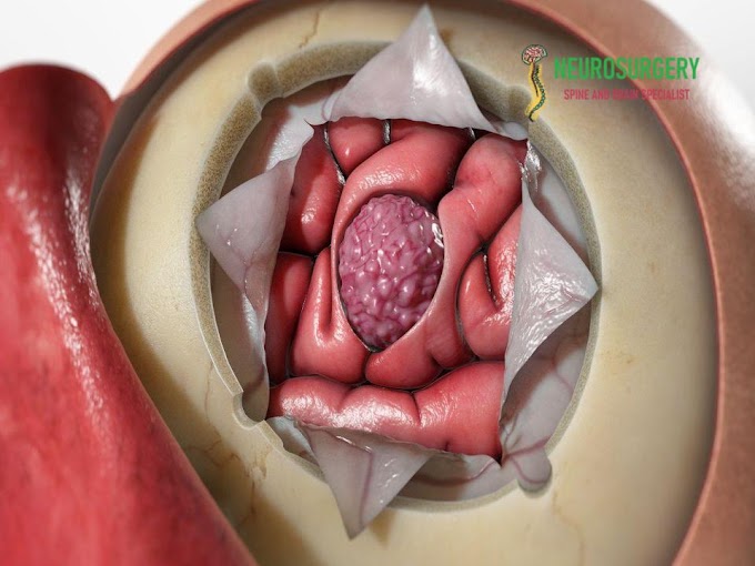 Meningioma: Symptoms, Risks And Treatments | Dr. Pramod Chaurasia