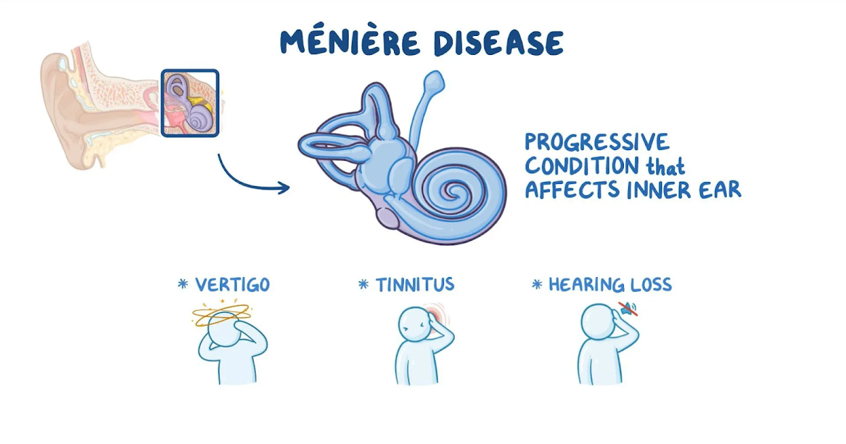 Smoking May Increase Odds Of Meniere Disease In Men  