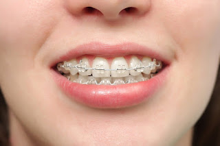 Quy trình thực hiện niềng răng hô -1