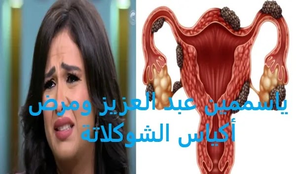 مرض أكياس الشوكولاتة الذي جعل ياسمين عبد العزيز طريحة الفراش