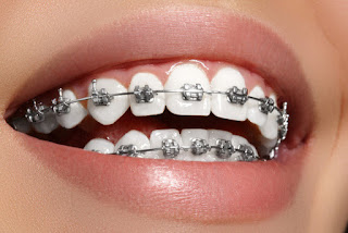 Niềng răng mắc cài kim loại là gì