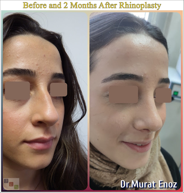 Before and 2 months after nose aesthetic operation - natural rhinoplasty - nose job istanbul