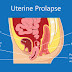 Uterine Prolapse । गर्भाशय का अपनी जगह से हट जाना