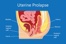 Uterine Prolapse symptoms ,Causes and Treatment in Hindi