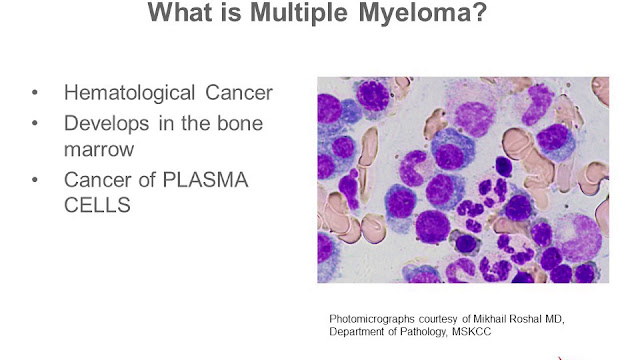 Pengobatan Multiple Myeloma