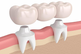 Làm cầu răng sứ có tốt không khi bị mất 2 răng?-1