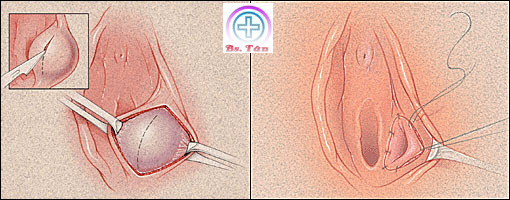 Viêm Tuyến Bartholin