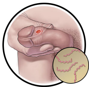 Syphilis ( उपदंश ) क्या है ? कारण, लक्षण और इलाज