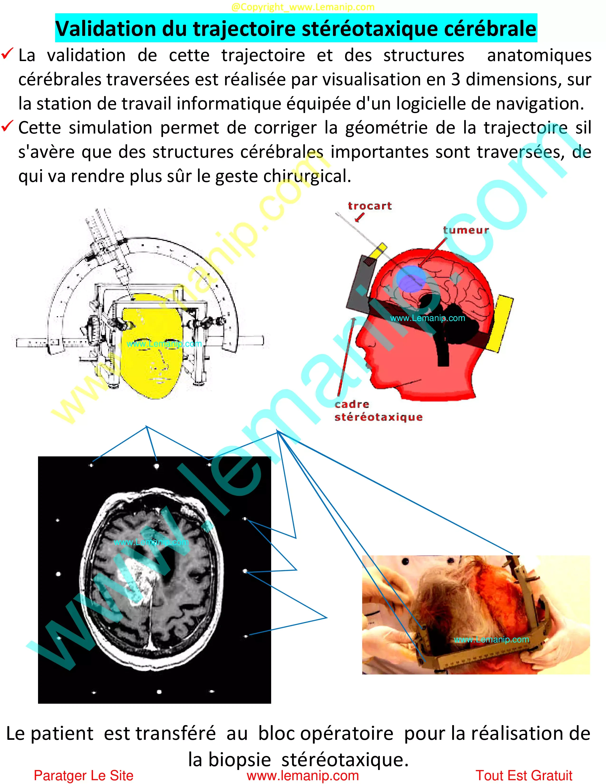 Validation trajectoire stéréotaxique cérébrale