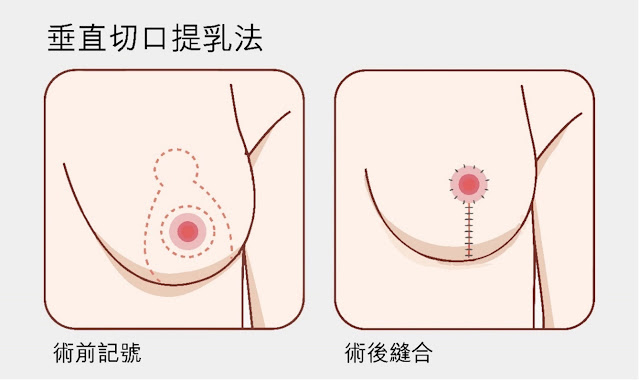 垂直短切口棒棒糖縮胸手術示意圖